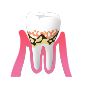 軽度の歯周病